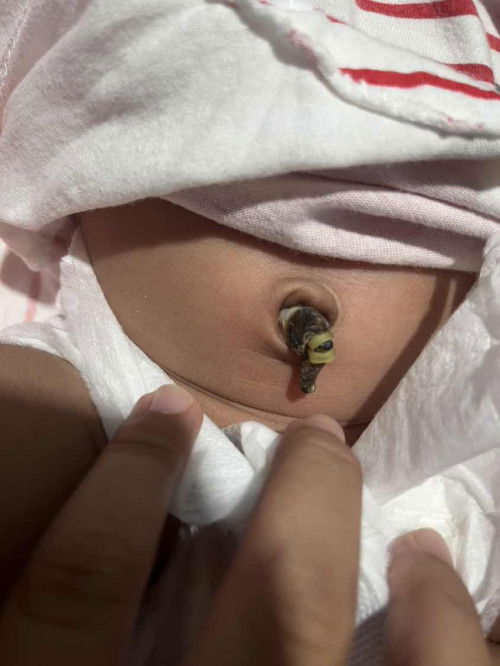 19วันสะดือยังไม่หลุดเลย