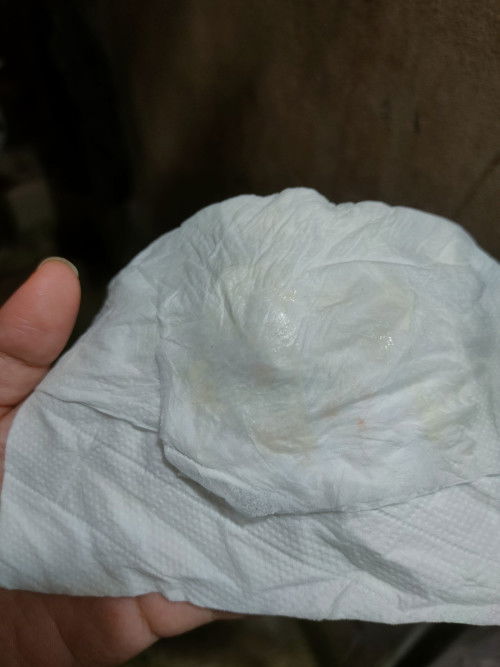 33w+1d เลือดออกจางๆ