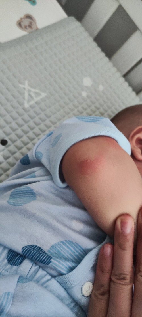 Muncul bentol merah pada bayi