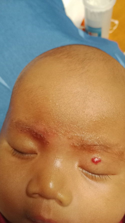 Dikelopak mata ada merah"