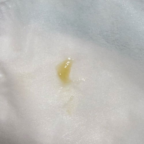 Yellow jelly discharge sa private part ni baby girl