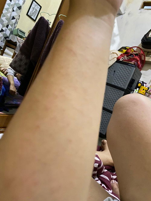 Bun mau tanya kalo gatal kaya gini lebih baik berobat atau engga ya?