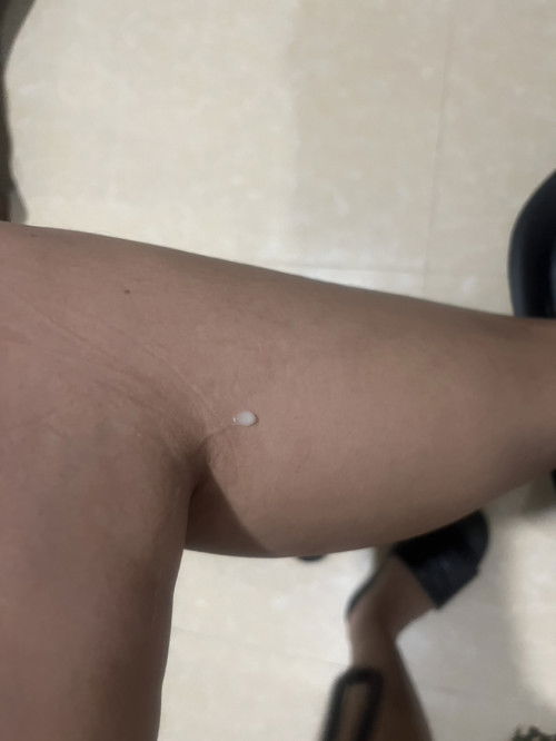 Milky white na discharge