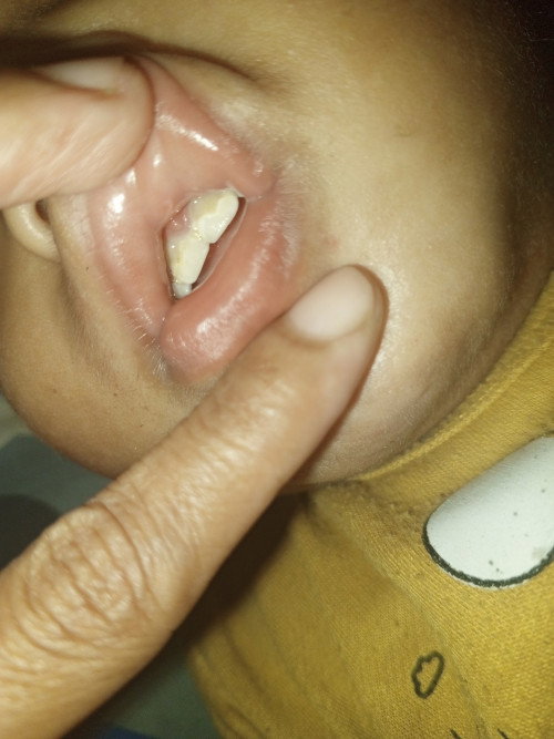 Gigi anak white spot