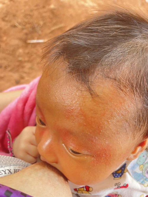 มียาอะไรแนะนำบ้างค่ะ🙏
(น้อง1เดือน4วัน)
แม่เครียดกับหน้าน้องมาก🥲