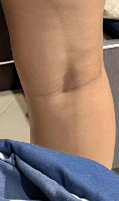 Belang pada kaki saat hamil /hiperpigmentasi di tm 3 cara mengatasinya gimana bunda”?