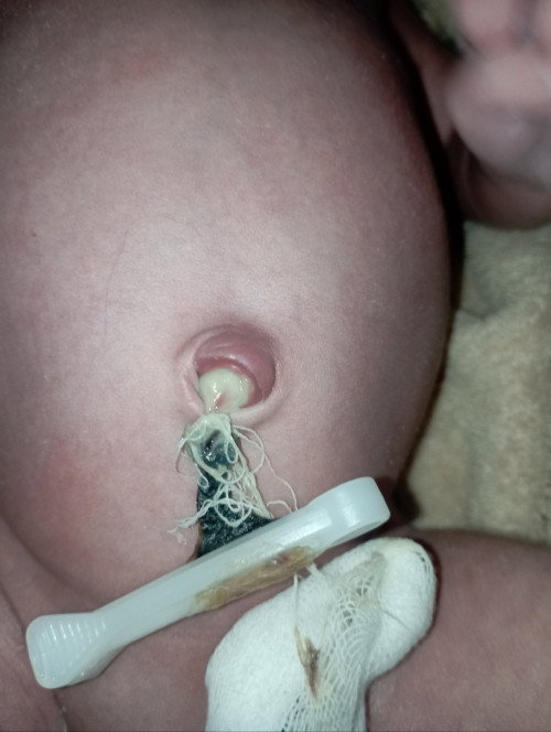 TALI PUSAR BAYI 6 HARI