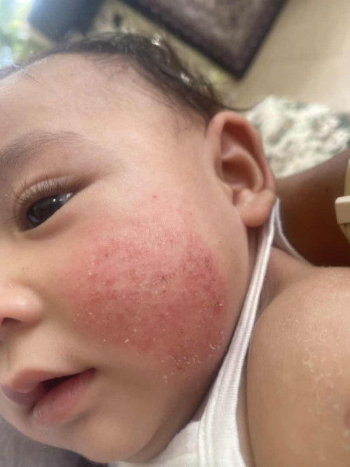 Eczema pada kulit anak 😢