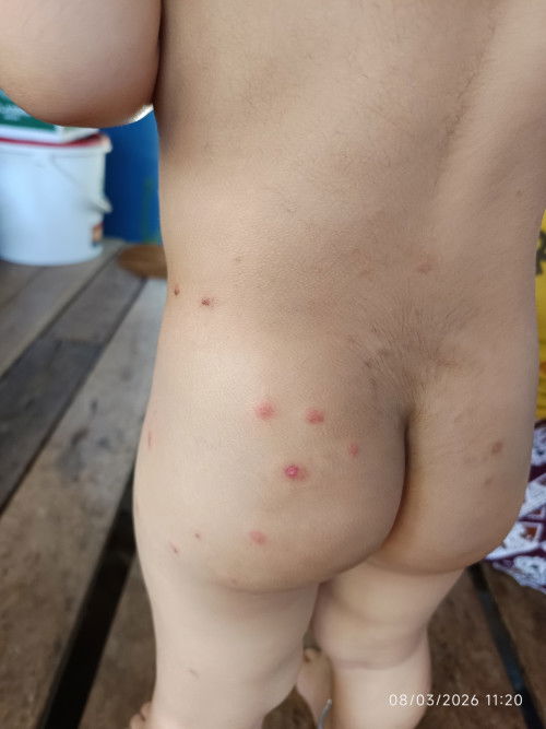 ตุ่ม ผื่น คัน