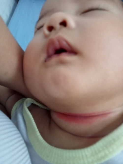 ano po kaya pwede gawin or igamot dito sa leeg Ng 3 month old baby ko namumula po leeg nya at mabaho