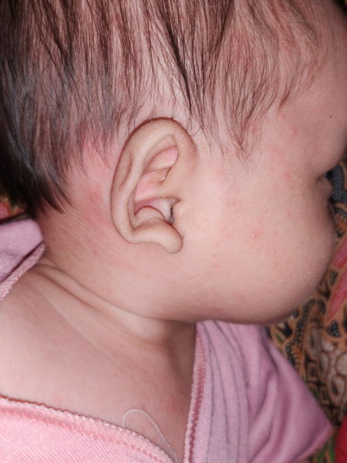 Merah merah seperti ruamkah?