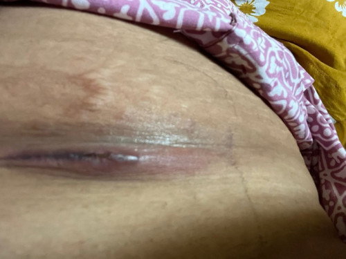 Luka SC H+14 meradang, perih , gatal dan agak nyeri ada yang sama kah ? minta solusinya bun ,