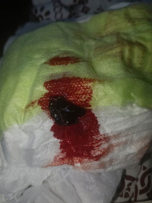 คนท้องไม่ควรมีเลือดออก