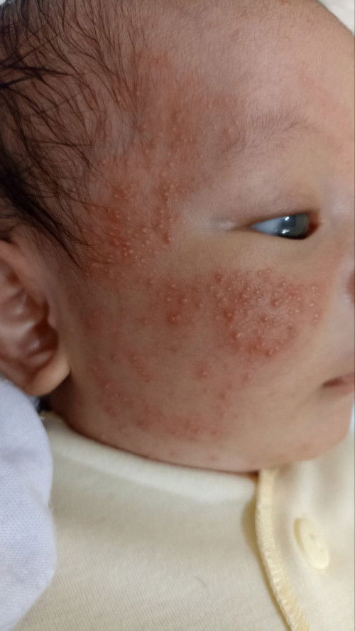 Muka Bayi Newborn bruntusan