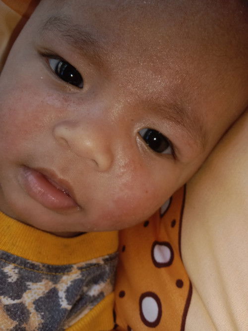 ผื่นแดงมีตายข้อพับบางจุดข้อศอกต้นขาไปหาหมอบอกว่าผื่นให้ซื้อครีมทาแต่พอยุบหายสนิทก็กลับมาขึ้นใหม่