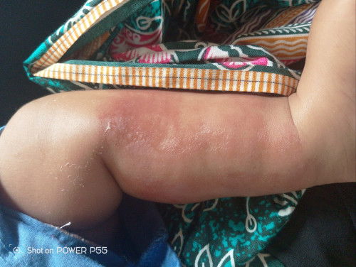 Gimana solusinya Bun kalo anak udh digigit serangga
Sampe memar kaya gini 
Kasihan liatnya🥹