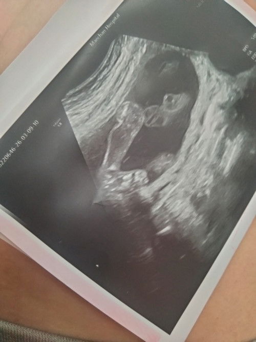 อยากถามว่าเสี่ยงเป็นเท้าปุกรึเปล่าคะ หมอส่งไปตรวจในเมืองวันพุธนี้
ถามว่าเครียดมั้ย เครียดค่ะ