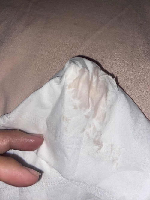 33+1 เลือดออก