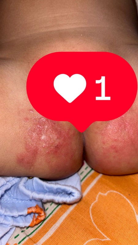 RUAM POPOK,DIARE+ DEMAM