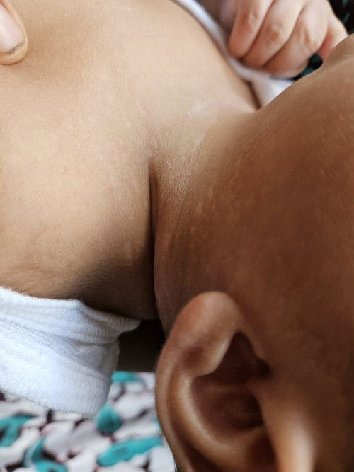 Bercak putih di leher