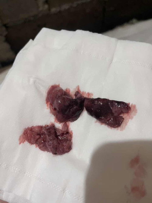 แบบนี้แท้งแล้วใช่ไหมค่ะ