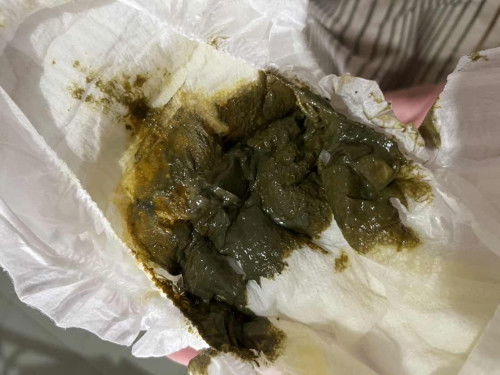 น้องถ่ายแบบนี้ปกติมั้ยคะน้องอายุสองเดือนกินนมหมีสูตรหนึ่งค่ะ ไม่มีงอแงไม่มีเบ่งเวลาถ่าย ถ่ายวันละหนึ่งครั้ง