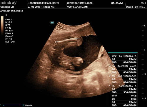 Scan baby girl or boy