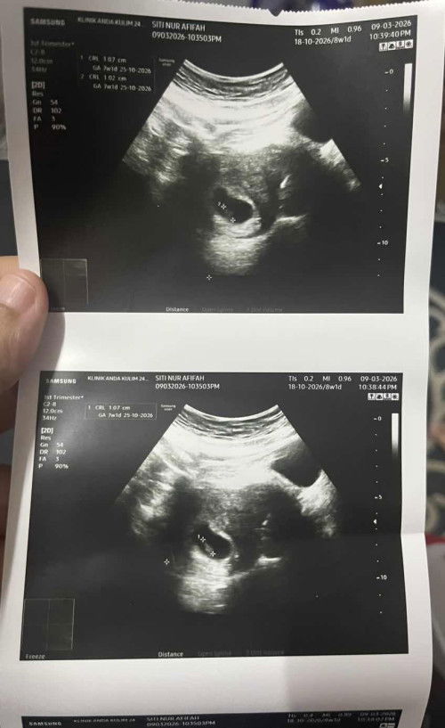 tak pasti twins atau cyst