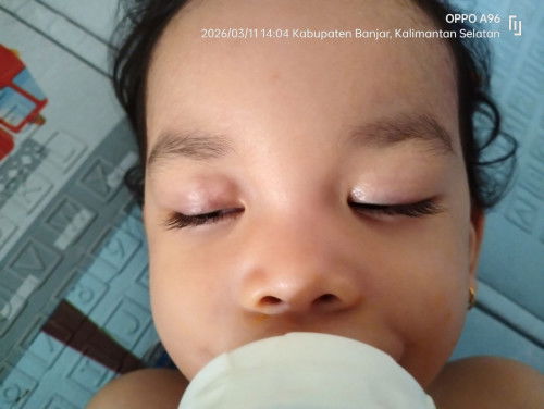 Kelopak mata bayi 21 bulan seperti bengkak