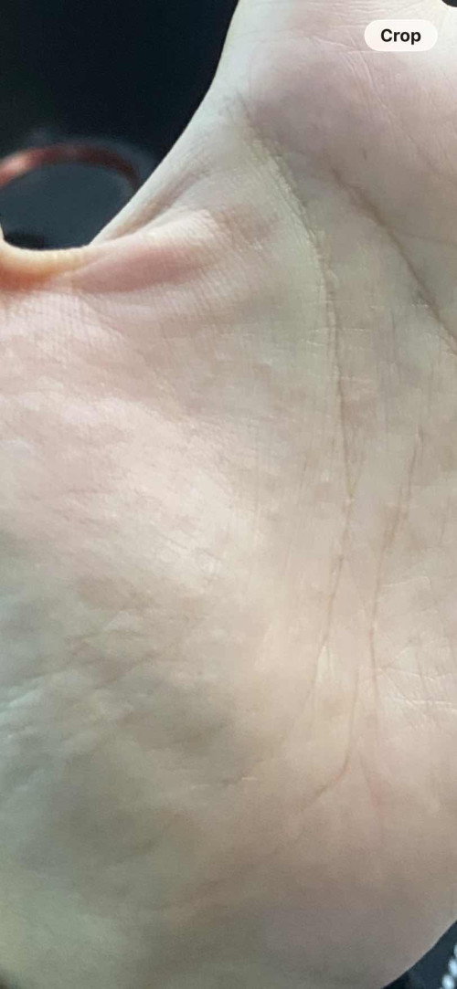 Gatal di telapak tangan dan kaki