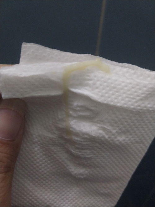 มีตกขาวสีเหลืองๆ?