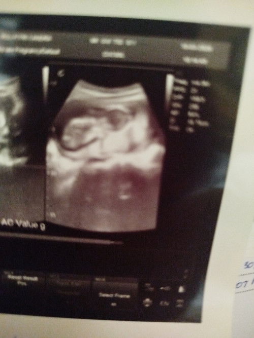 Usia kandunganan 14week