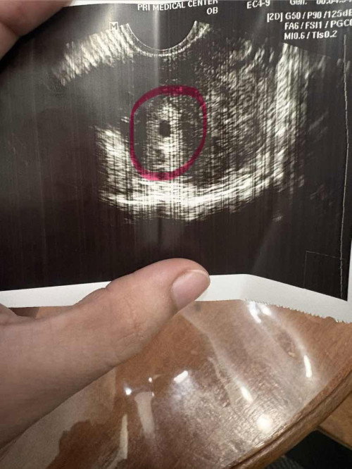 Transvaginal Ultrasound