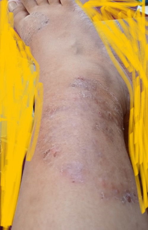 Cara menghilangkan bekas gatal