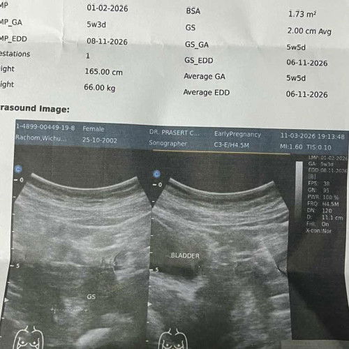 น้องจะหลุดไหม