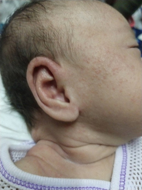 Heat rashes ataupun sebab susu formula tak ngam ya?