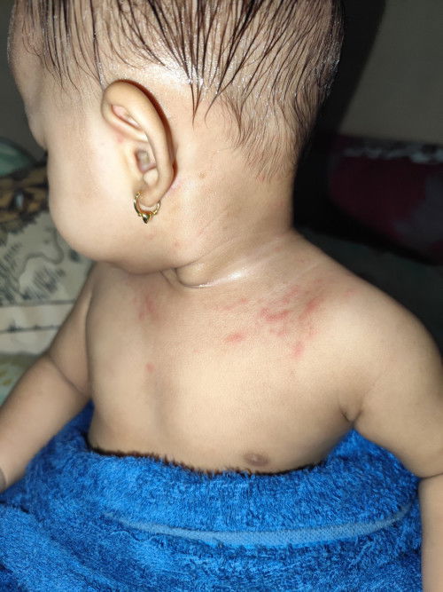 Ruam ruam pada bayi 9 bulan