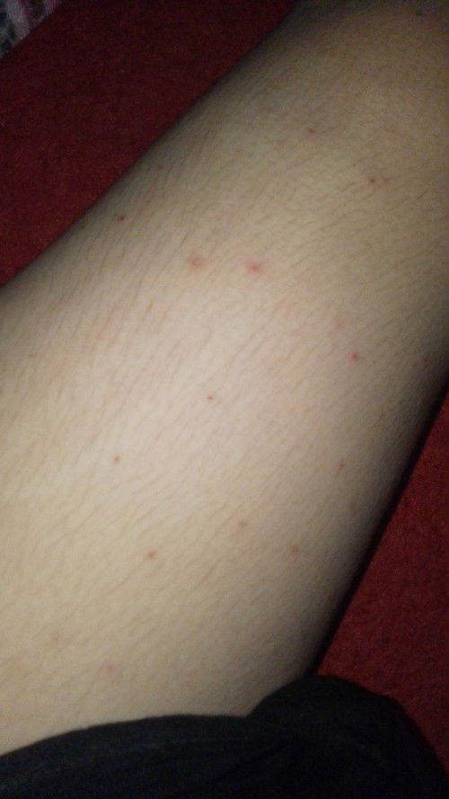 Bun, ada yang sama gak semenjak tm 2 gatal² trus muncul bintik bintik merah kehitaman?..