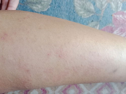 Gatal saat menjadi busui