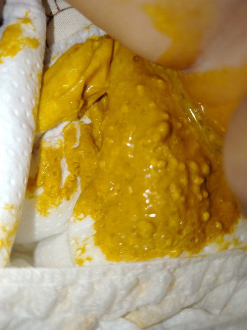 อึเด็ก1ด.23ว.