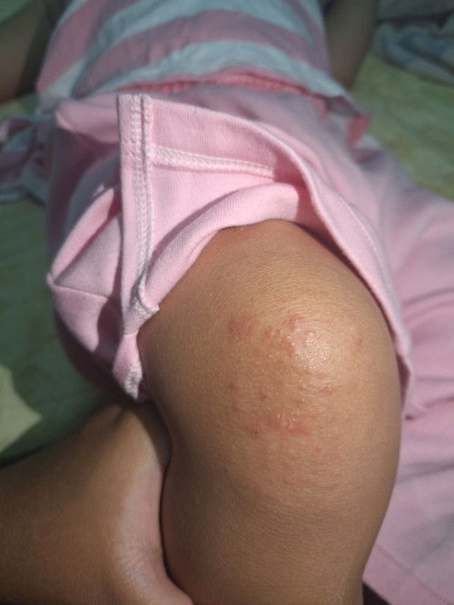 ผื่นแบบนี้