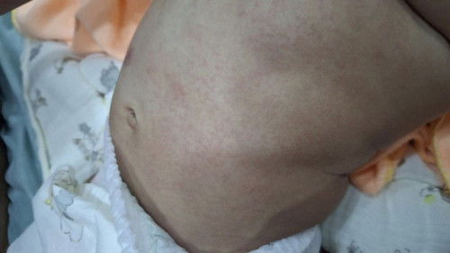 อันนี้ผดร้อนหรืออาหารแพ้อาหารหรือแพ้นมค่ะ