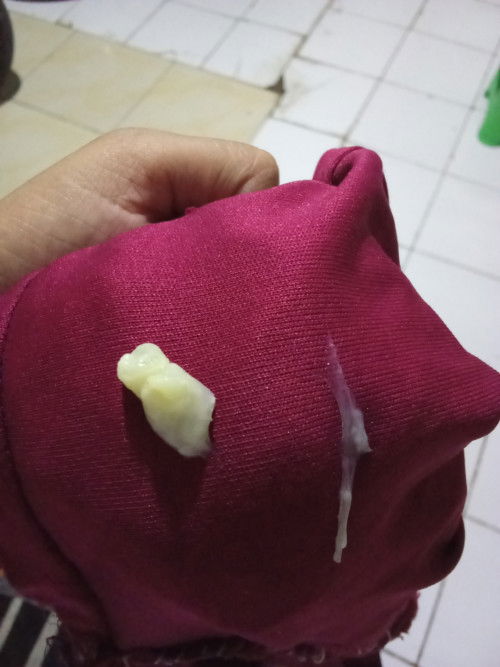 Keputihan dikehamilan 21week