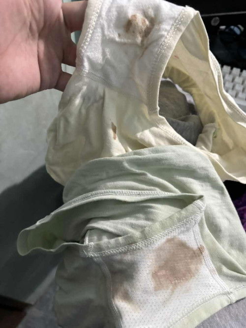 Brown blood-like discharge