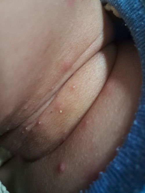 Gatal gatal pada bayi