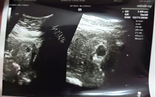 Hi sy scan semalam. 5w2d nampak kantung. Dr suruh repeat 2minggu lagi. Adakah normal?