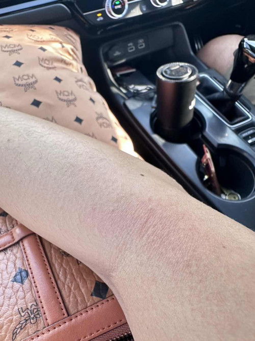 31Weeks เริ่มมีตุ่มแปลกๆ