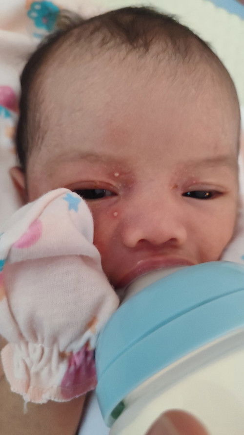Bayi 1 minggu muncul bentol seperti jerawat di sekitar mata