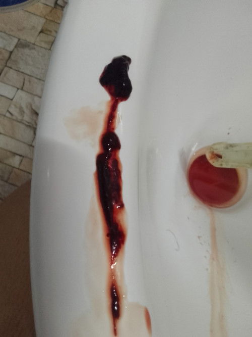 2วันก่อนมีเลือกสีนํ้าตาลเข้มไปหาหมอบอกว่าถุงตั้งครรยังอยู่มาวันนี้มรเลือดสีเเดงออกยังนี้7สัปดาค่ะ