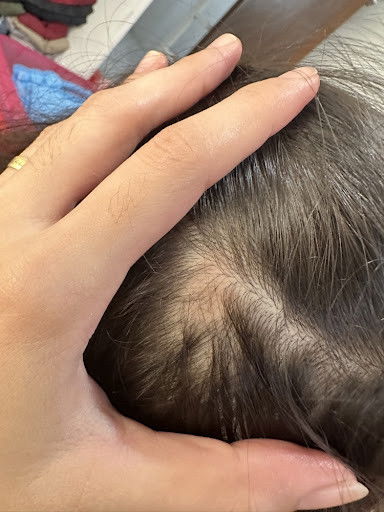 Bukol mula sa pagkauntog 3 months ago